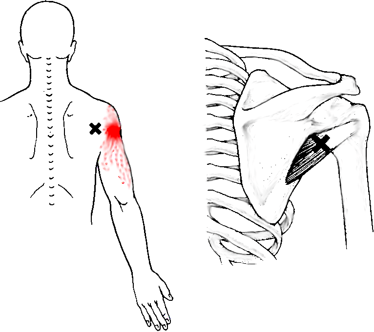 Exemple de trigger point avec zone de douleur rayonnante